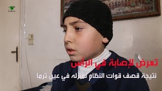 الطفل يمان بين مطرقة الحصار وسندان القصف المستمر.. الغوطة_الشرقية..