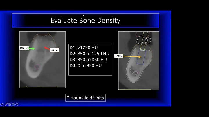 Video Case Study 1 - CBCT Planning By Dr Resnik