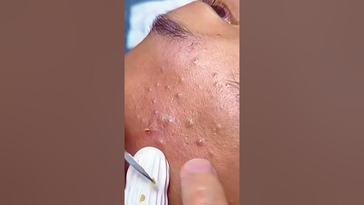 Huge Blackhead Extraction Extremely Satisfying! YouTube