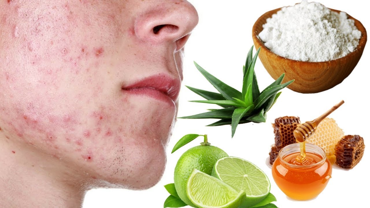 4 Cara Alami Menghilangkan Bekas Jerawat / Home Remedies For Acne Marks