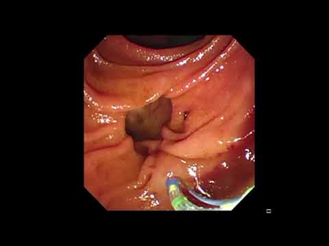 LeoMed Rotatable Sphincterotome