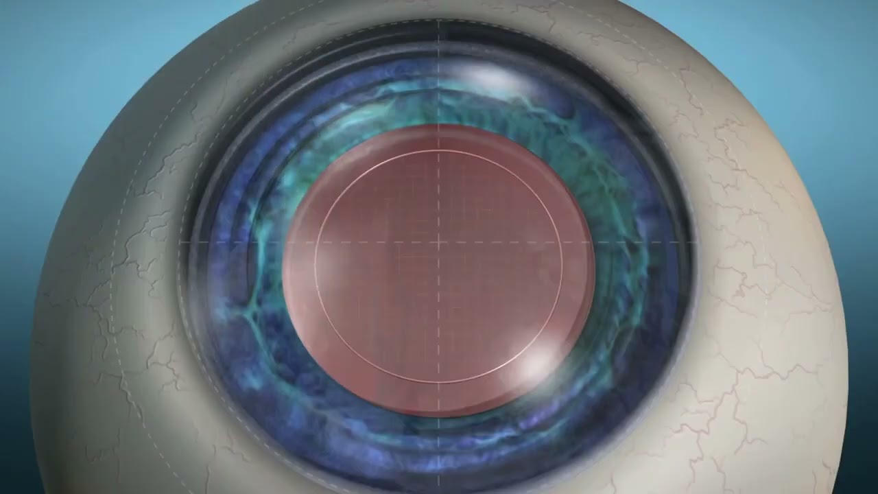 LenSx Laser Cataract Surgery