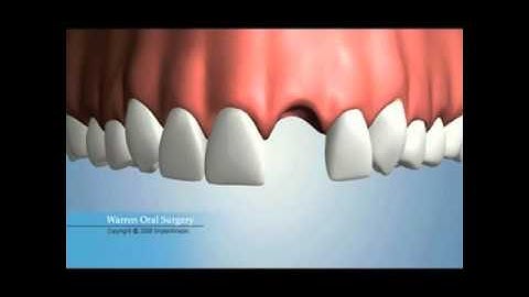 Single Missing Tooth Replacement Options