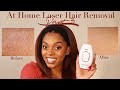 AMAZING RESULTS!!! IPL Home Laser Hair Removal Update Part 3 || Glow Like a Goddess!