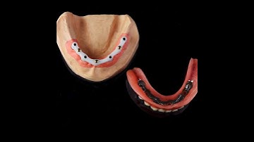 Bar with Locator over Denture