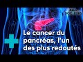 Cancer du pancréas, quels progrès ? - Le Magazine de la Santé