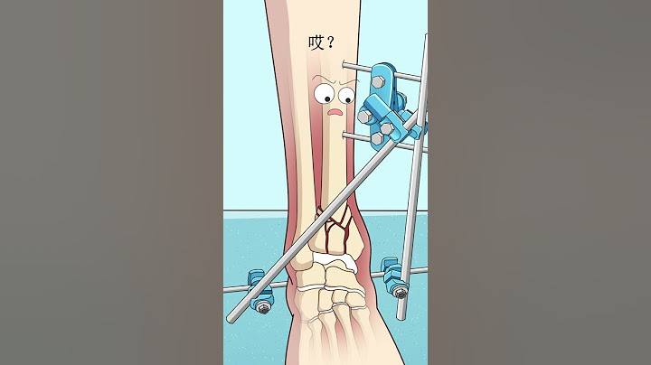 脛骨骨折外固定External fixation of tibial fractures - 天天要聞