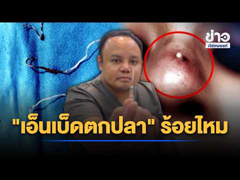 Beauty clinic accused of using fishing line for thread lifting procedure | Workpoint Morning News...