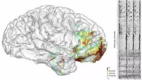 Ictal Cinema - Visualizing Real Seizure Activity in the Human Brain