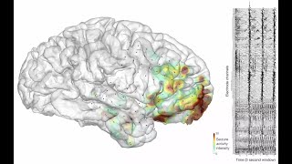 Ictal Cinema - Visualizing Real Seizure Activity In The Human Brain
