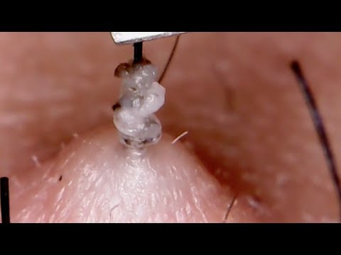 Video: Ako Sa Zbaviť Blackheads: 12 Spôsobov