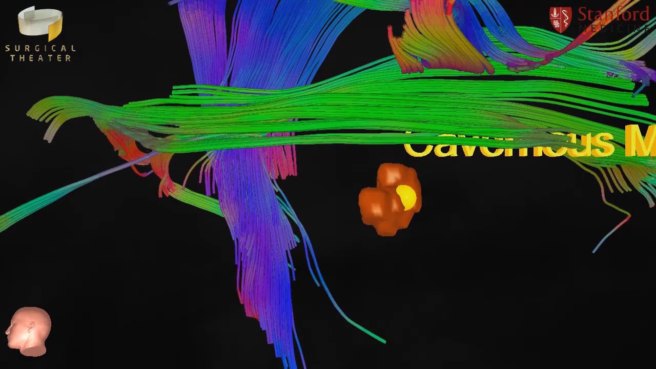 Stanford Neurosurgery Virtual Reality Lab's Anatomy in 3D: Cavernous Malformation