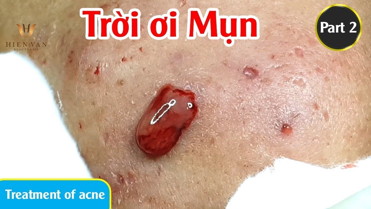 Cyst Acne | Điều trị mụn u nang khổng lồ hiệu quả tại TPHCM | Hiền Vân spa |573