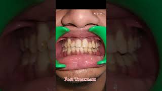 Cleft Palate patient|| Treatment with Self ligating Braces|| Dr Abhinav Shrivastava MDS