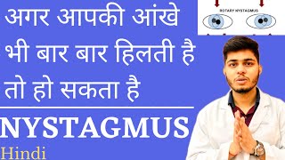 आखों का बार बार हिलने का क्या संकेत है । NYSTAGMUS CAUSES AND Treatment screenshot 1