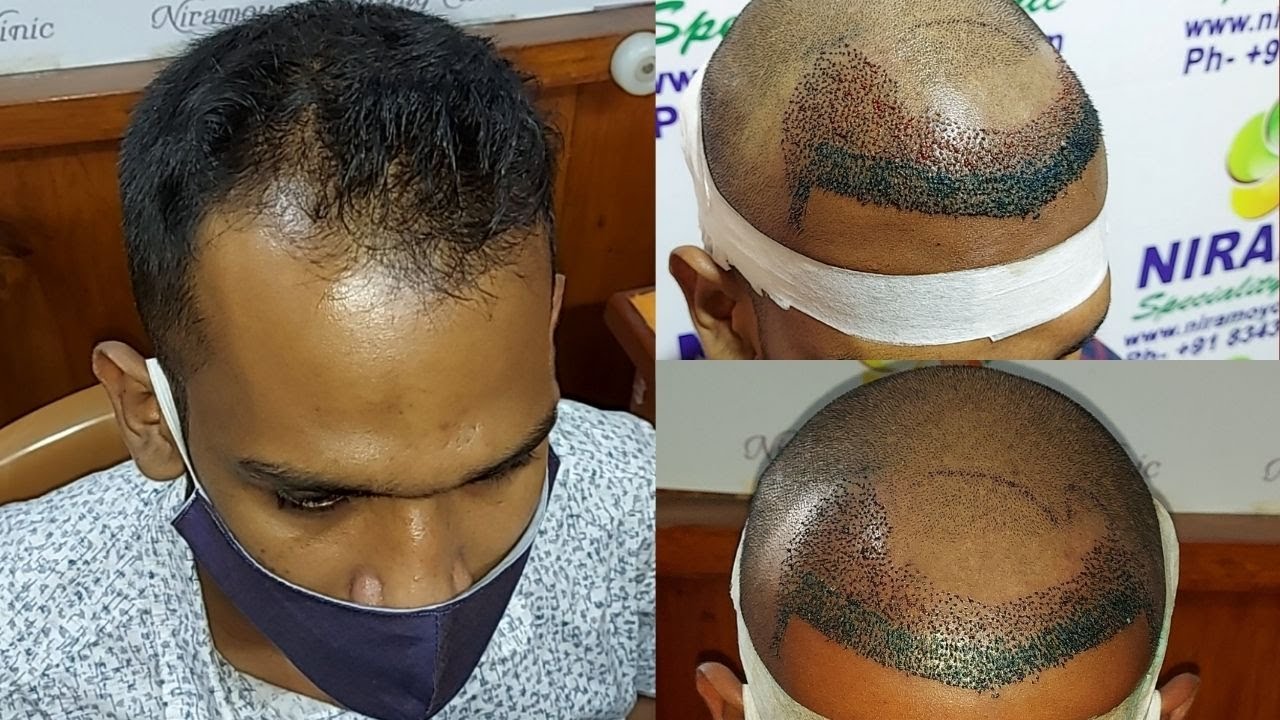 Hair Transplant Kolkata FUE Method Grafts ? Time ? Cost ? Results