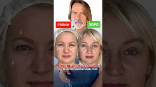 Supersoft Lifting: A Natural Facial Refresh with Just a Few Days of Recovery