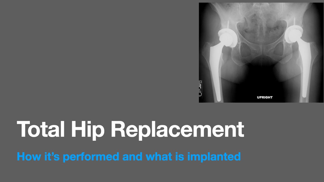 Total Hip Replacement - OrthoInfo - AAOS