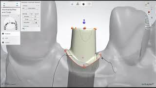 Dental Lab Life: Designing an Abutment in 3Shape