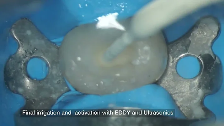 VDW Dental · Grande & Plotino  RECIPROC blue Vídeo clínico de preparación paso a paso