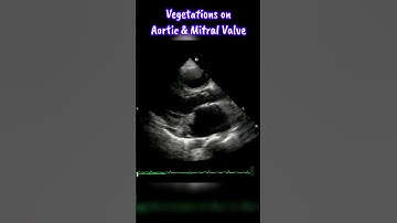 Infective Endocarditis invloving Mitral and Aortic Valve #heart #shorts #echocardiography