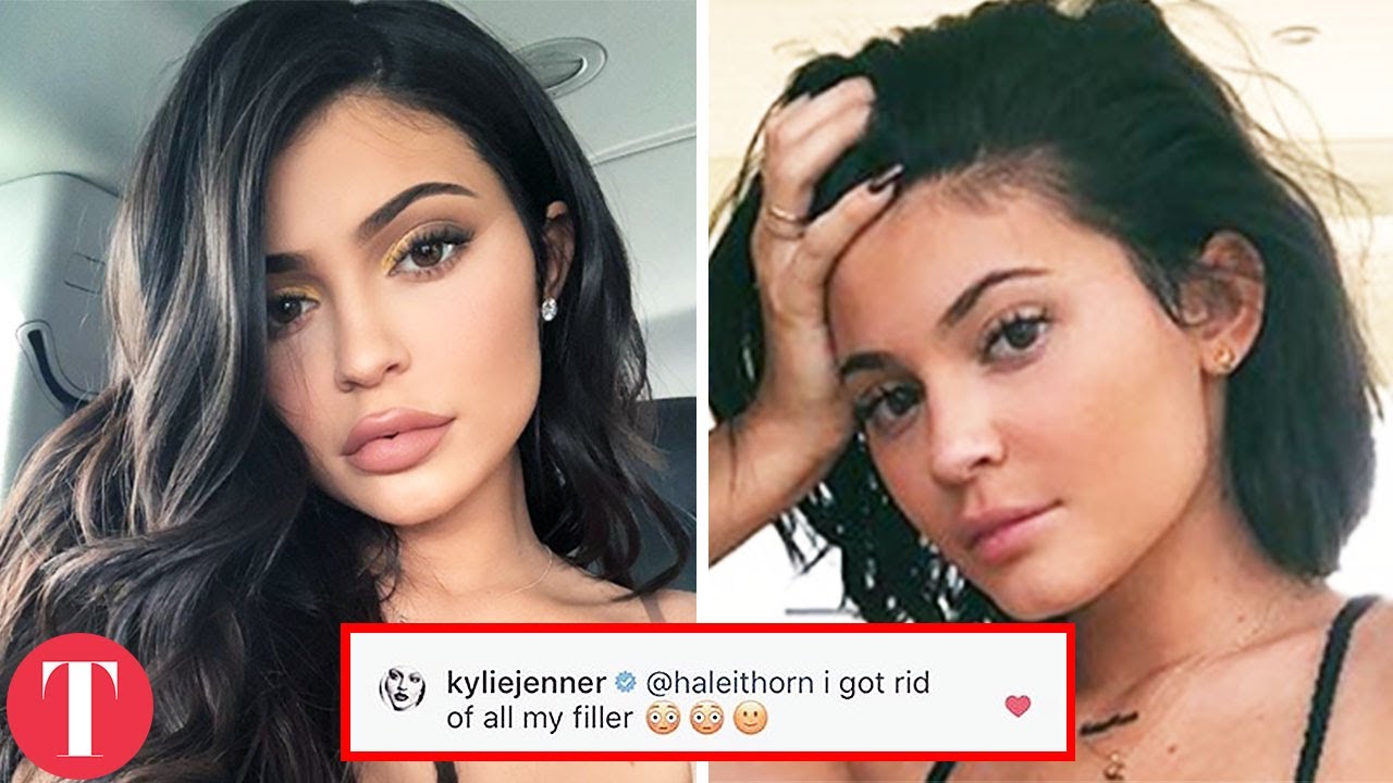 Kylie Reveals The Truth About Her Lip Fillers And Why She Took Them Out
