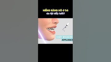 răng hô ở trẻ cần niềng sớm (do tật đẩy lưỡi)
