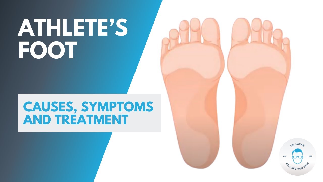 Athlete's Foot (Tinea pedis): Symptoms, Causes & Treatment - Foot