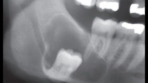 Well-defined, Unilocular Radiolucencies in the Jaws