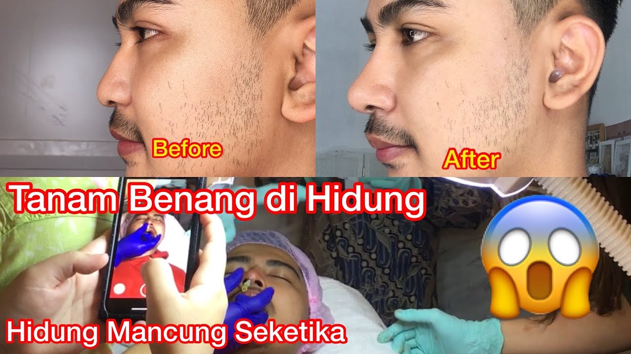TANAM BENANG HIDUNG ( MANCUNG SEKETIKA) by Beauty First ...