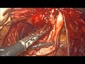 Conservative surgery for severe  endometriosis with bilateral chocolate cysts