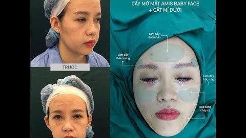 Cắt Mí Mắt Hỏng Bao Lâu Sửa Lại Được ❓ - Sửa Lỗi Thẩm Mỹ - D’Vincy