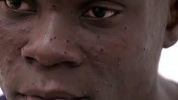 Congo receives long-awaited mpox vaccine doses | REUTERS