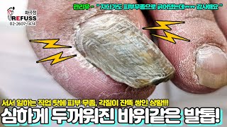 심하게 두꺼워져서 바위같아진 발톱!!? 서서 일하는 탓에 피부 무좀, 각질이 잔뜩 쌓인 발톱ㅠㅠ #레푸스 #refuss #내성발톱 #무좀발톱 #무좀 #toenails #현희킴