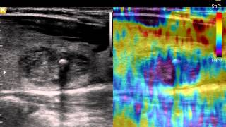 Эластография при УЗИ щитовидной железы(При проведении эластографии отчетливо видны участки с повышенной плотностью, соответствующие расположени..., 2013-10-30T07:00:31.000Z)