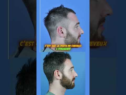 Vidéo: 14 façons de réduire la perte de cheveux