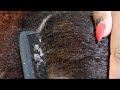 ITCHY DRY SCALP | SCRATCHING DANDRUFF | RAKING SCALP