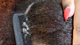 ITCHY DRY SCALP | SCRATCHING DANDRUFF | RAKING SCALP