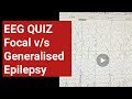 EEG QUIZ - focal v/s generalised epilepsy