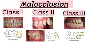 malocclusions..Class I,Class II,Class III..Clinical features..Quick Revision