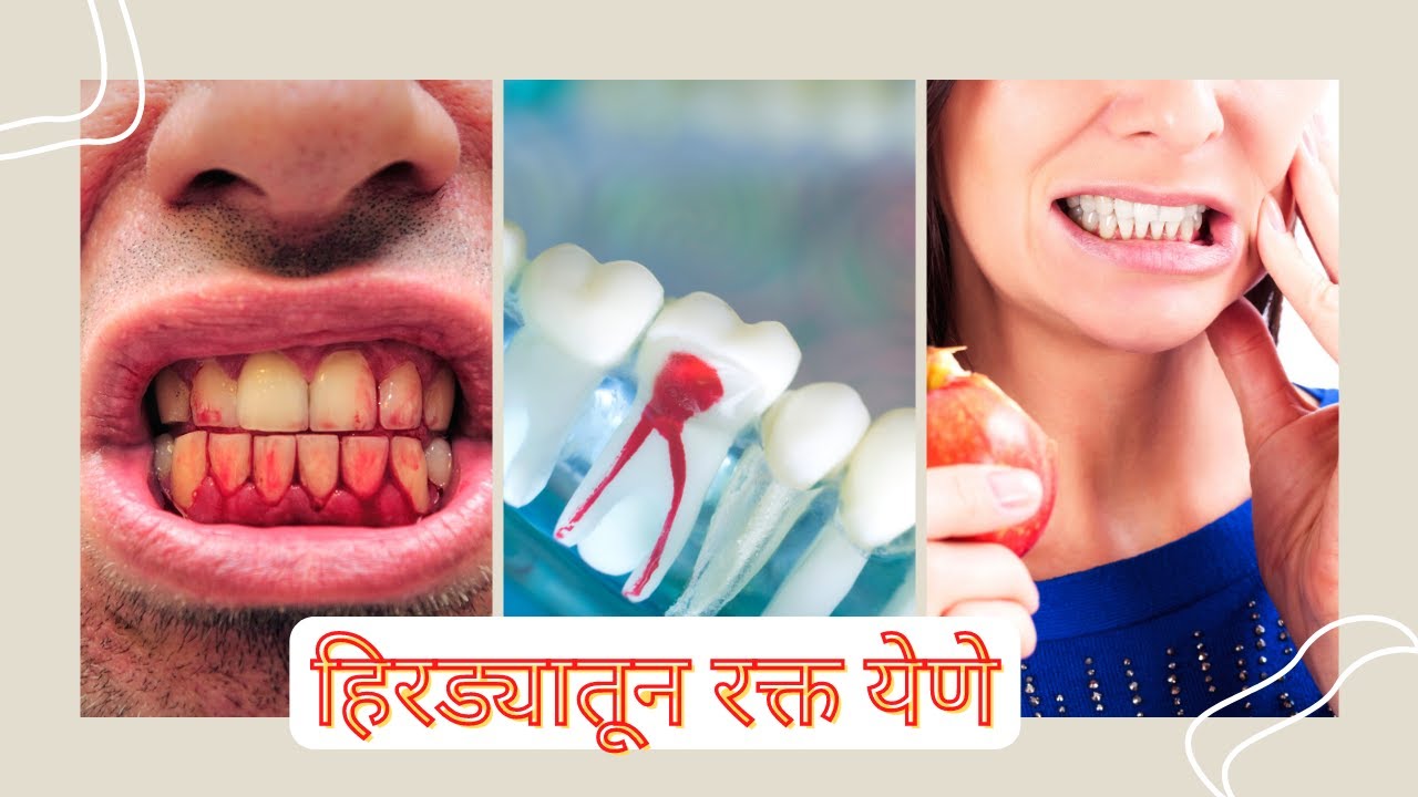 How to Stop Gum Bleeding? in Marathi How to deal with Bleeding Gum? How to treatment gums Bleed  #Homeopathic