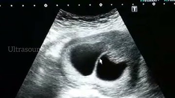 Lambda Sign In Twins Pregnancy