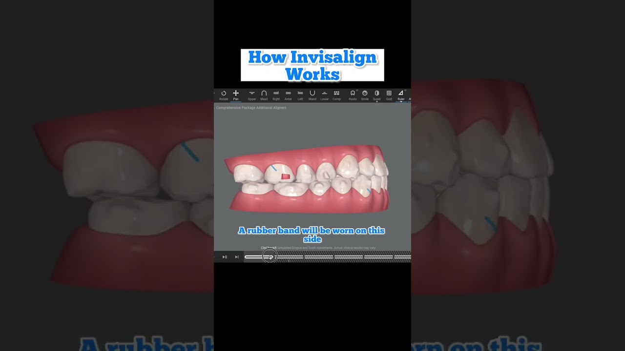 How Invisalign Works: Doing Clincheck smile design on computer software.