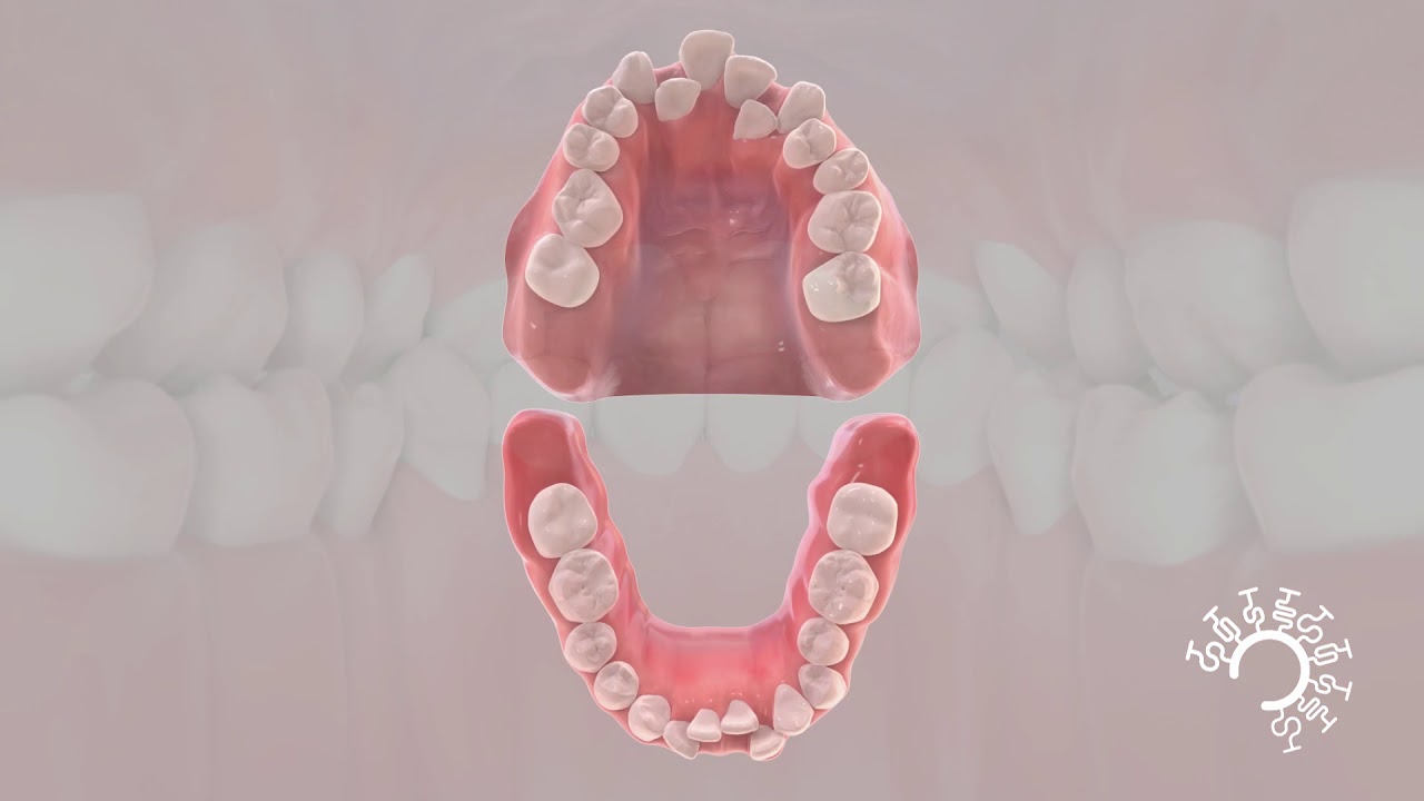 Mechanodontics Lingual Braces Houston YouTube