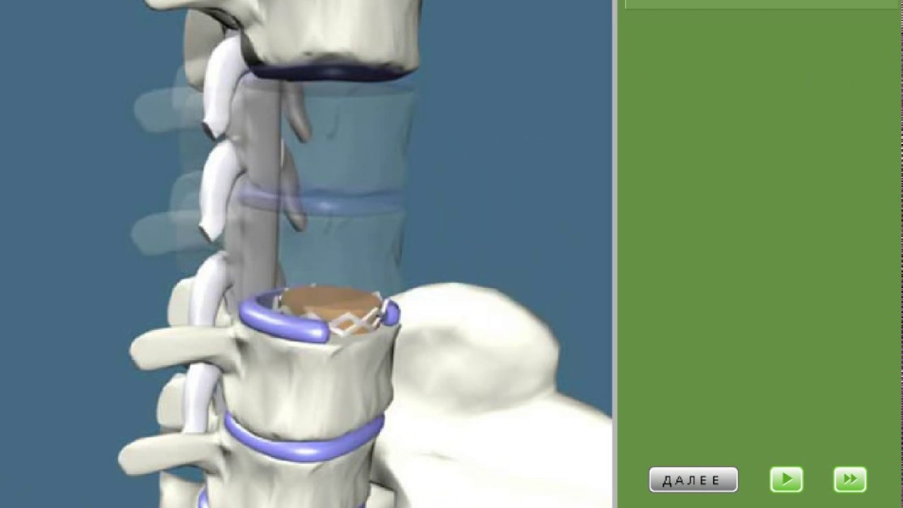 Лечение межпозвоночной грыжи поясничного отдела операция