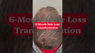 Male hair loss transformation after 6-months #DrHopkirk #HRP™️ #hairlosstreatment #hair #hairloss