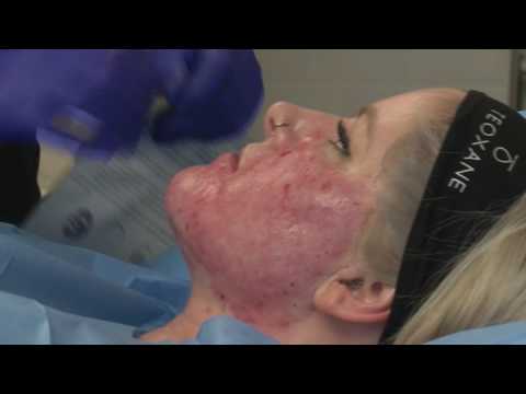 How to Get Rid of Acne Scars - Revolutionary Treatment - Dr Ian Strawford at Skin Excellence Clinics