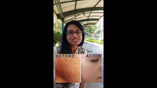 Open Pores खुले रोम छिद्रों को कैसे बंद करें   ?Treatment at home 100% Natural DailyHealthTip -10