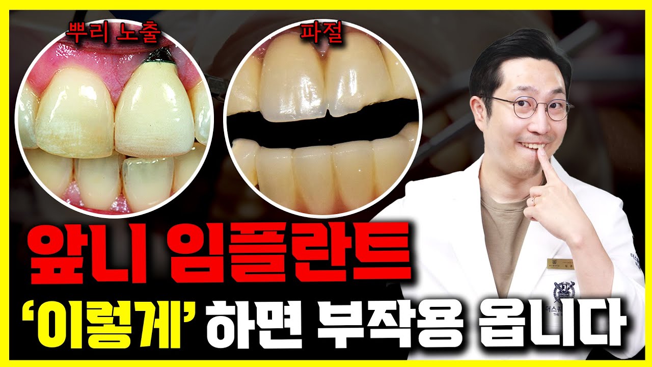 난이도 높은 앞니 임플란트, 잘못하면 부작용 옵니다 | 앞니임플란트 후기, 과정, 부작용 원인