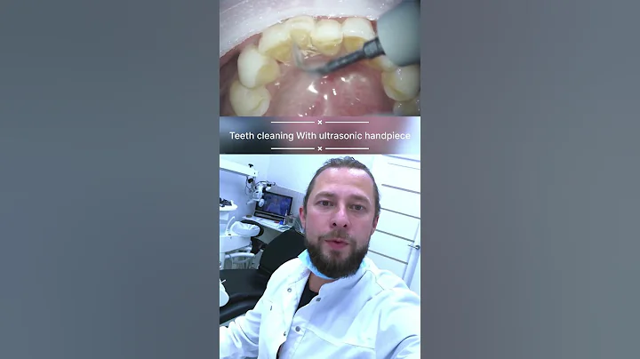 Teeth cleaning with ultrasonic hand piece , teeth cleaning tartar and plaque #teeth #dentist #denta